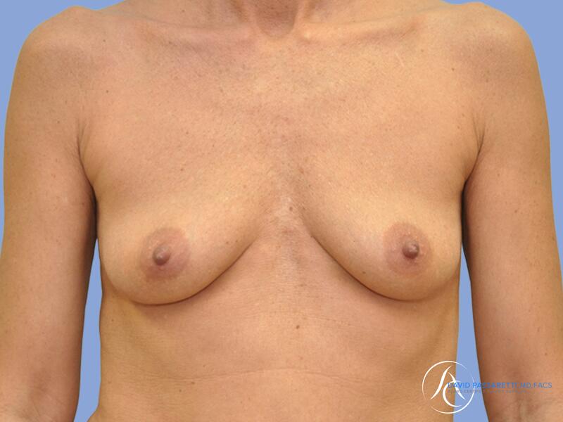 Breast augmentation before & after photo