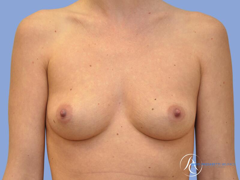 Breast augmentation before & after photo