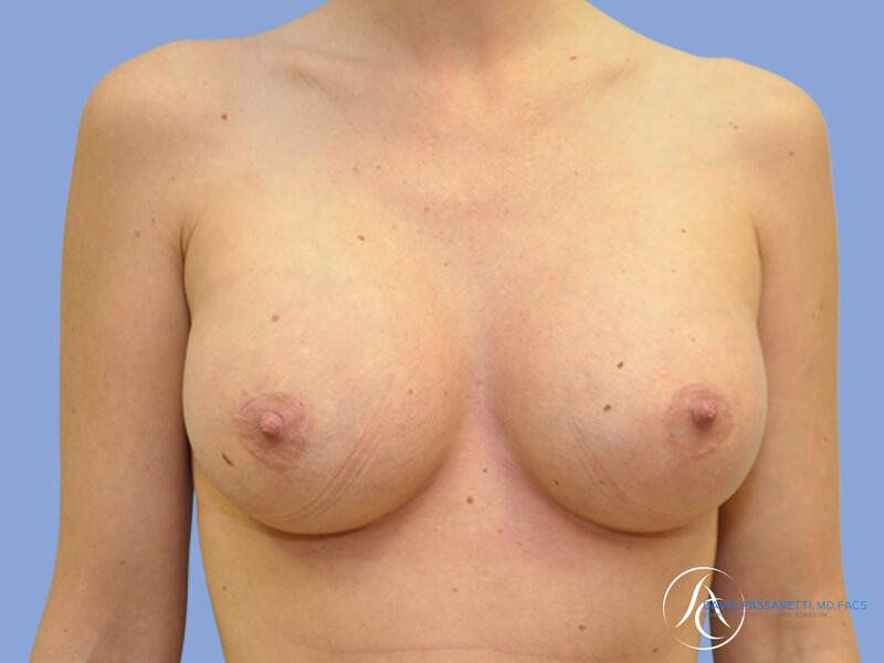 Breast augmentation before & after photo