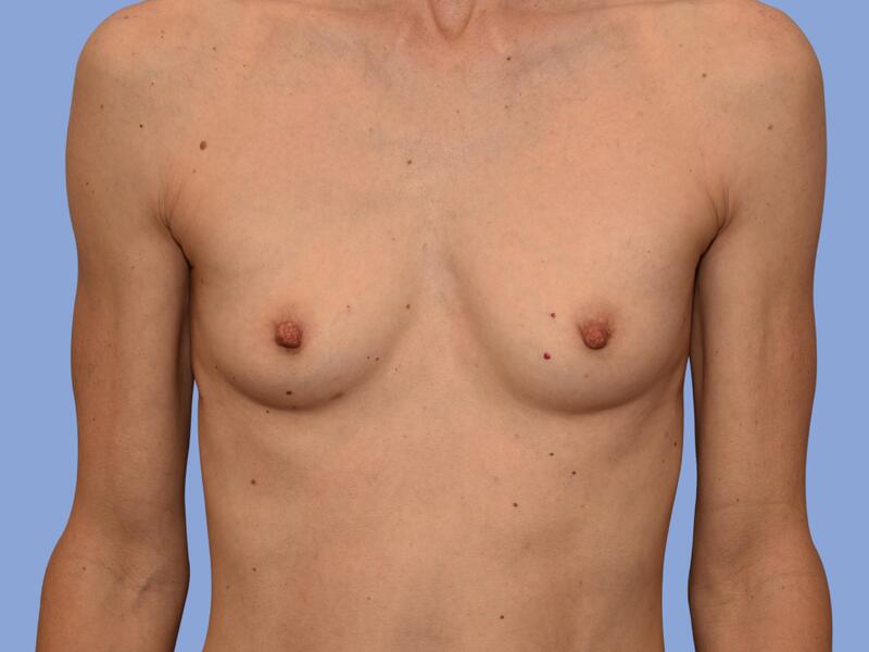 Breast augmentation before & after photo