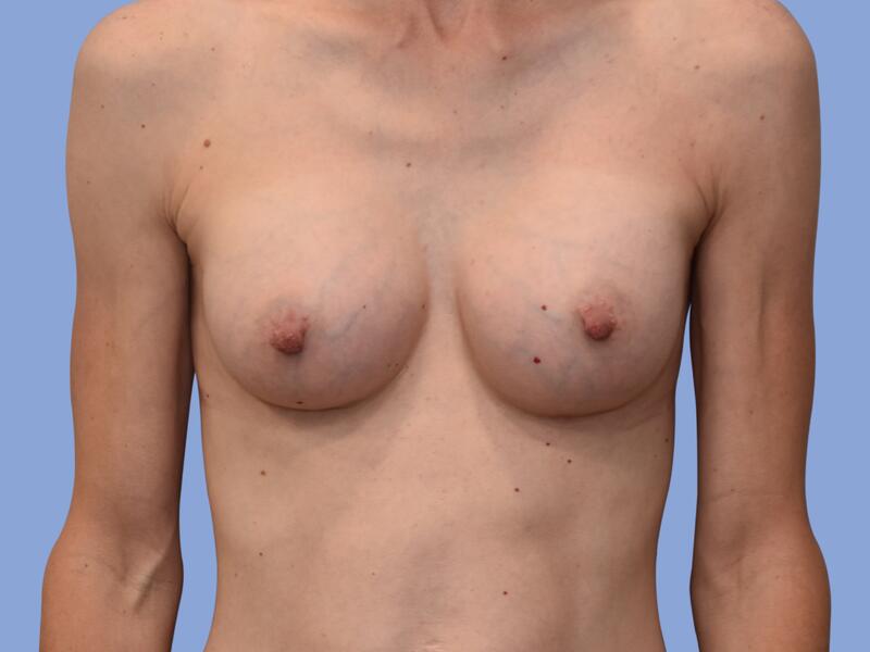 Breast augmentation before & after photo