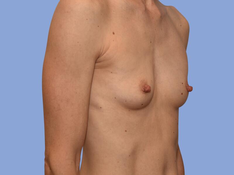 Breast augmentation before & after photo