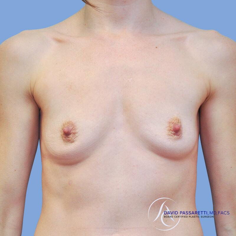 Breast augmentation before & after photo