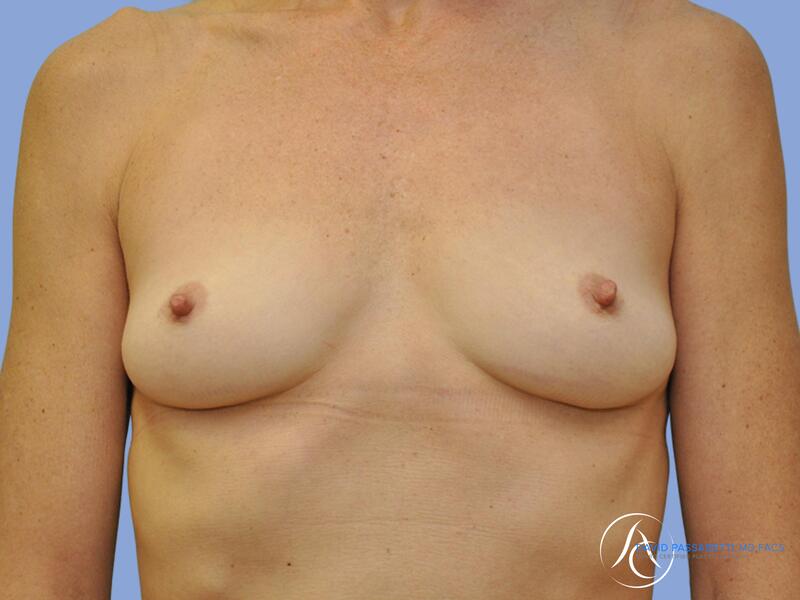 Breast augmentation before & after photo