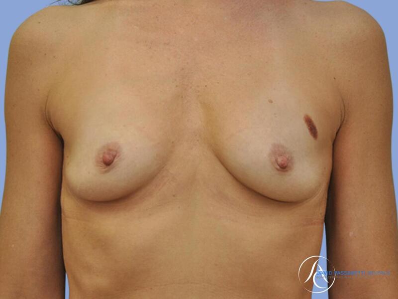 Breast augmentation Before & After photo