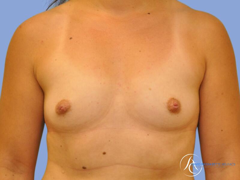 Breast augmentation before & after photo