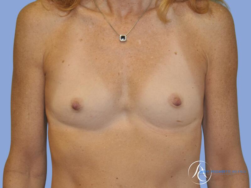 Breast augmentation before & after photo