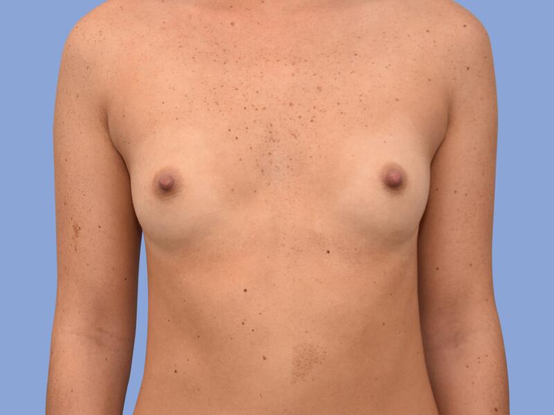 Breast augmentation before & after photo