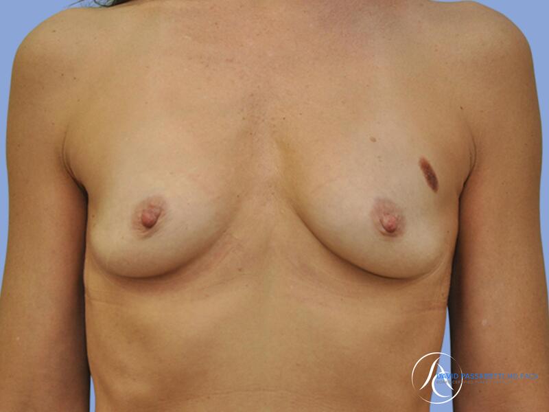 Breast augmentation before & after photo