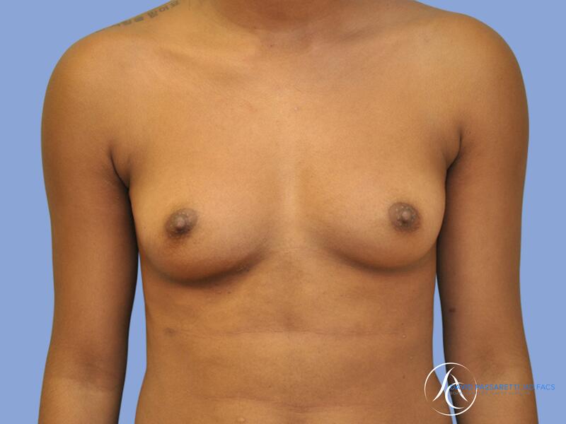 Breast augmentation before & after photo