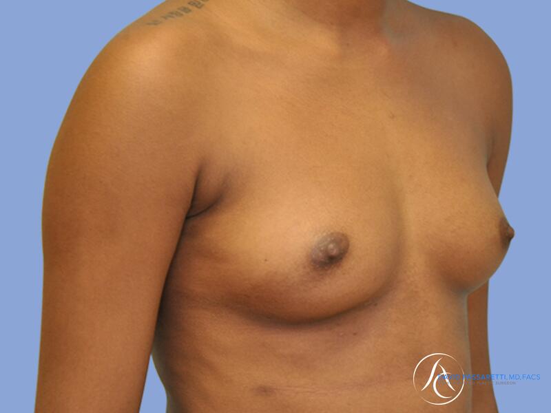 Breast augmentation before & after photo