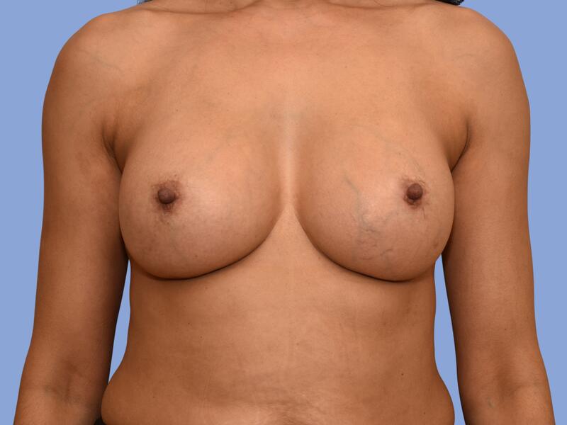 Breast augmentation before & after photo