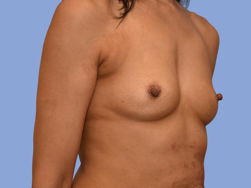 Breast augmentation before & after photo