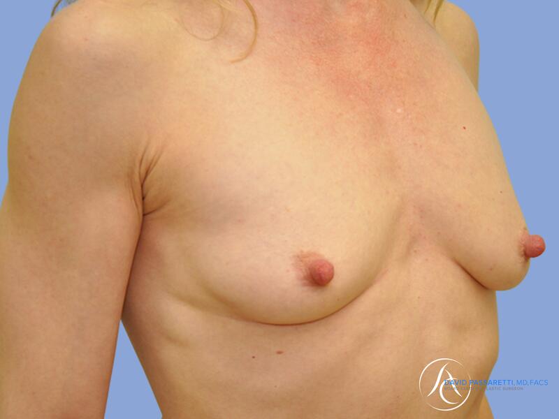 Breast augmentation before & after photo