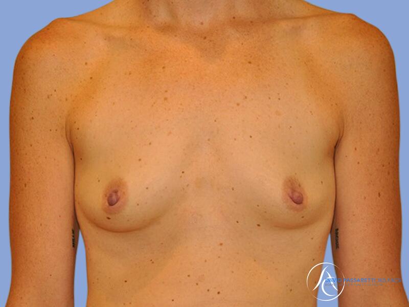 Breast augmentation before & after photo