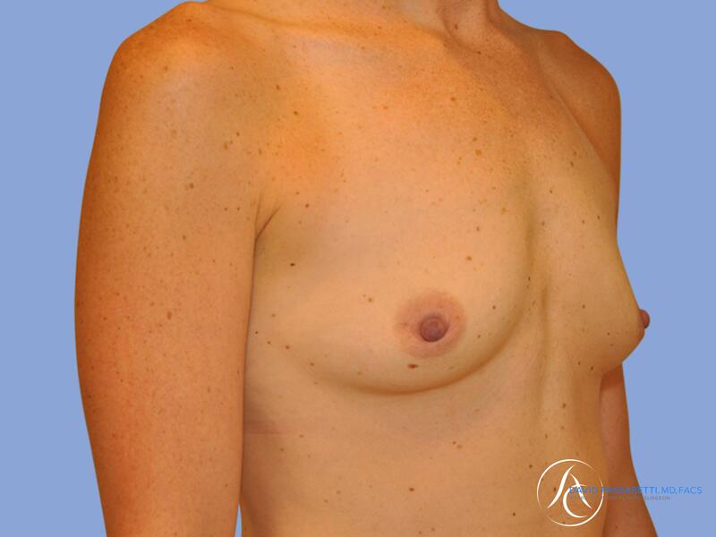 Breast augmentation before & after photo