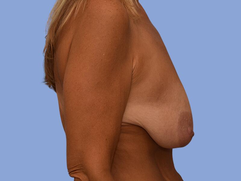 Breast augmentation before & after photo