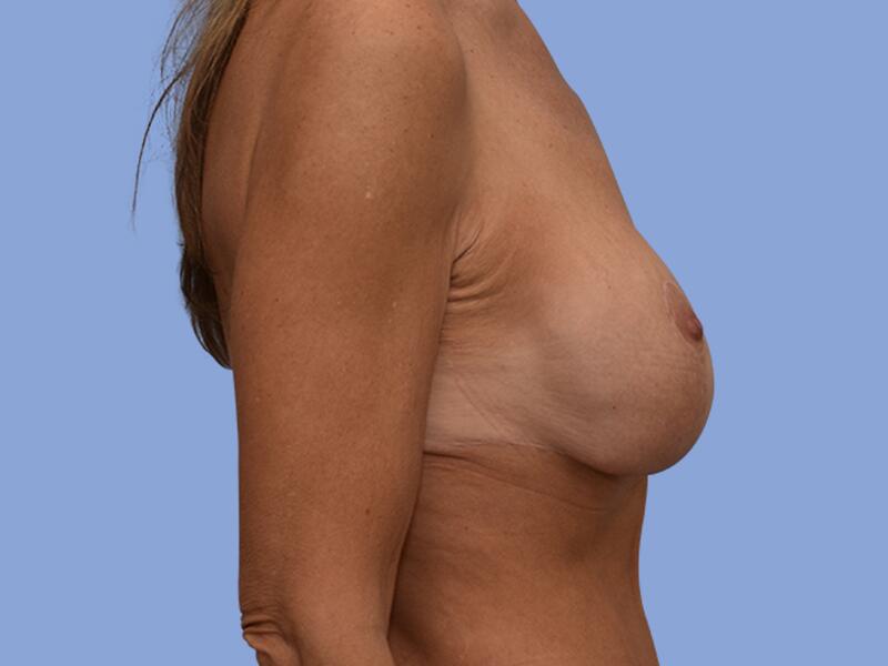 Breast augmentation before & after photo