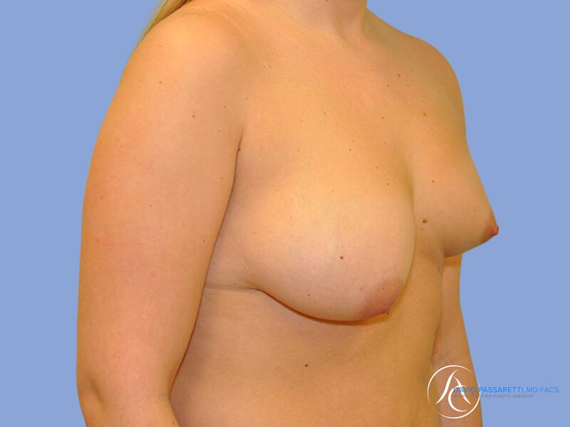 Breast augmentation before & after photo