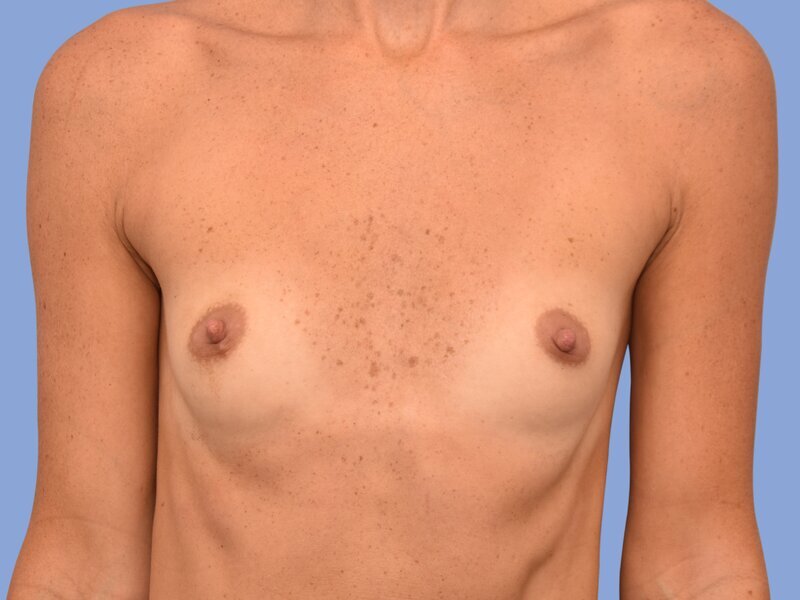 Breast augmentation before & after photo