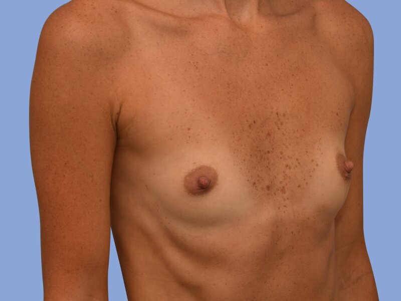 Breast augmentation before & after photo