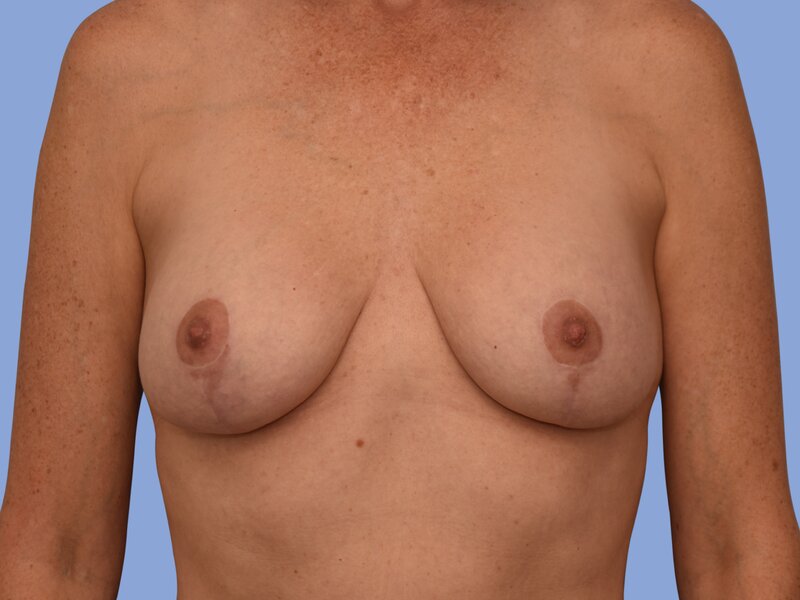 Breast augmentation before & after photo