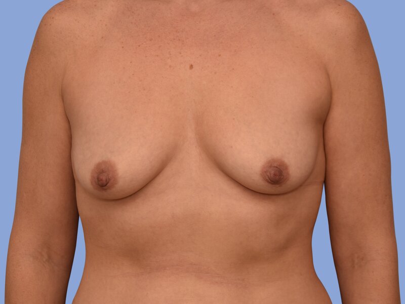 Breast augmentation before & after photo