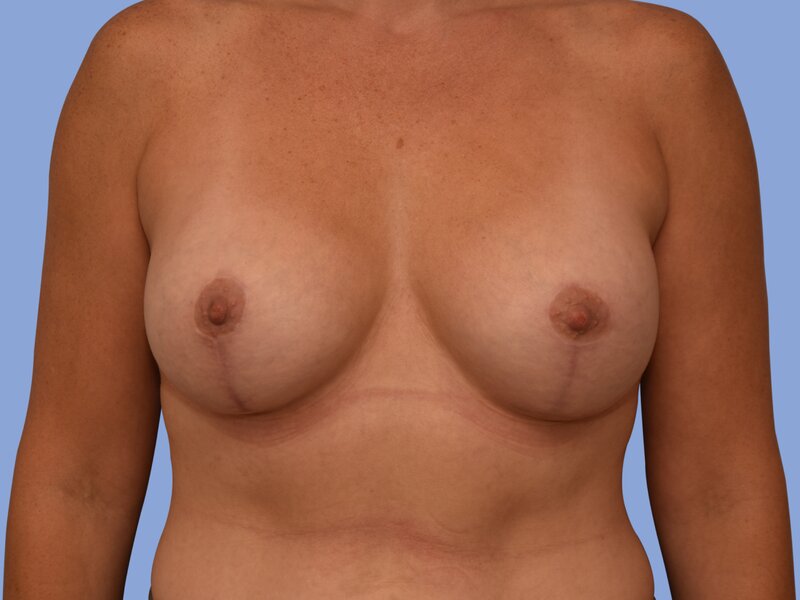 Breast augmentation before & after photo