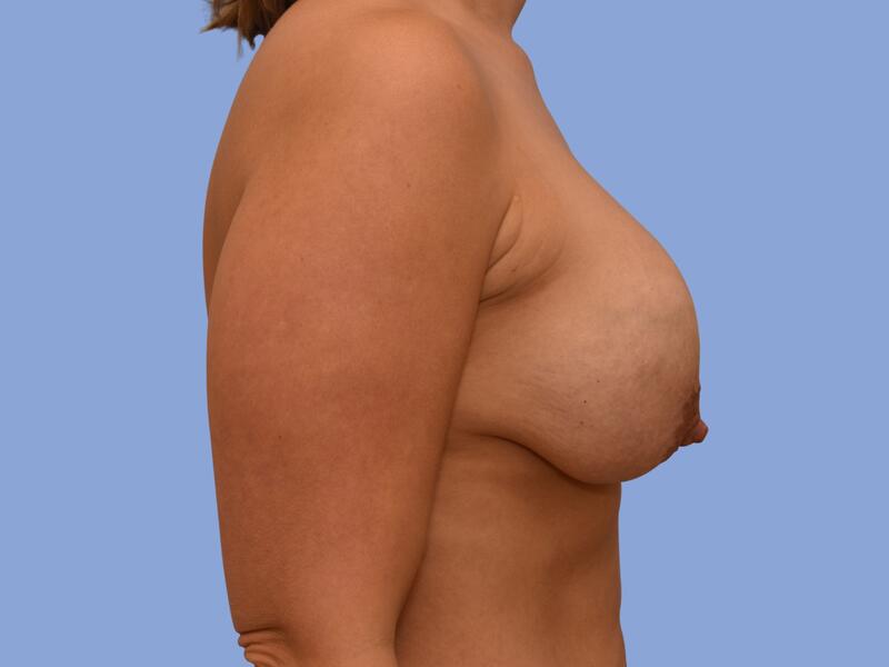 Breast implant revision before & after photo