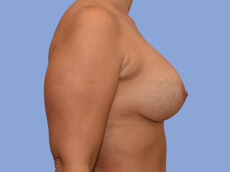 Breast implant revision before & after photo