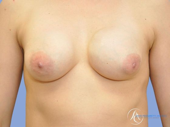 Breast implant revision Before & After photo
