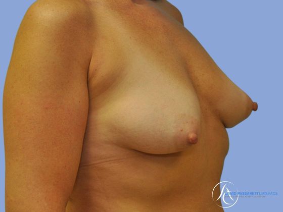 Breast implant revision before & after photo