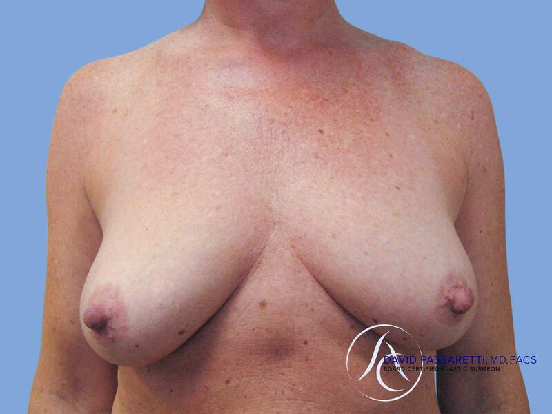 Breast implant revision before & after photo