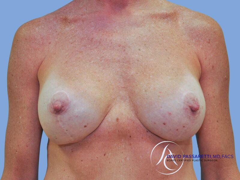 Breast implant revision before & after photo