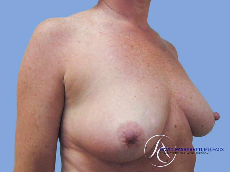 Breast implant revision before & after photo