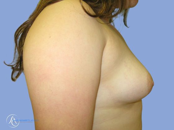 Breast implant revision Before & After photo