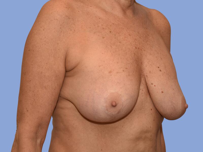 Breast lift before & after photo