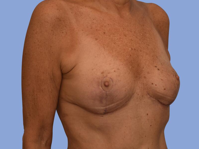 Breast lift before & after photo