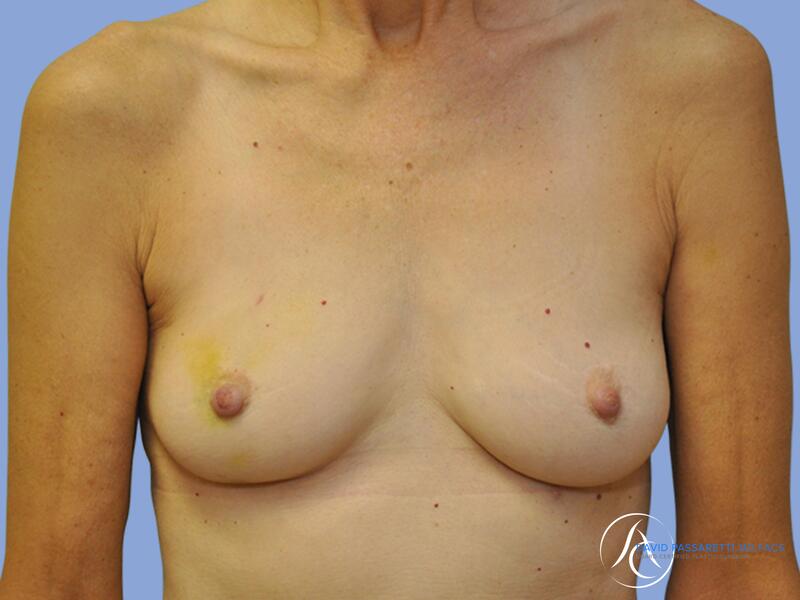 Breast reconstruction before & after photo