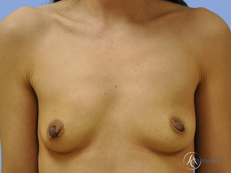 Breast reconstruction before & after photo