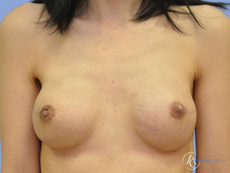 Breast reconstruction before & after photo