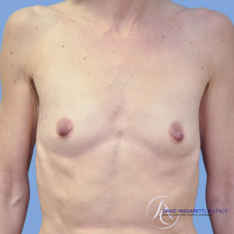 Breast reconstruction before & after photo