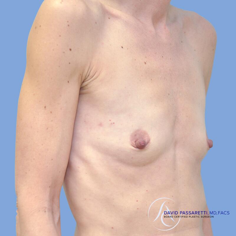 Breast reconstruction before & after photo