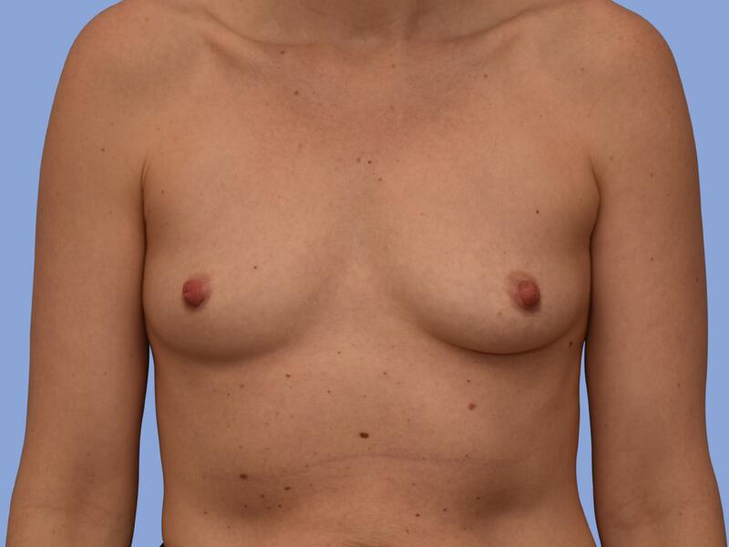 Breast reconstruction before & after photo