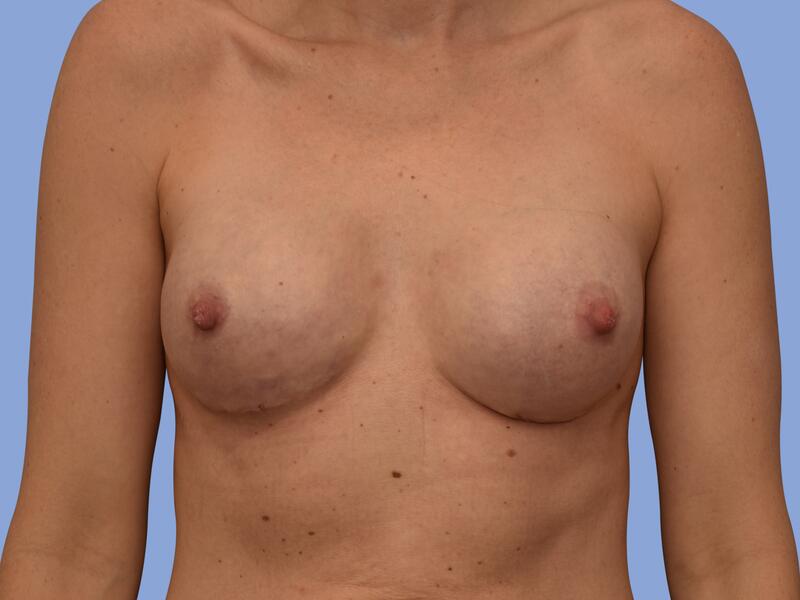 Breast reconstruction before & after photo