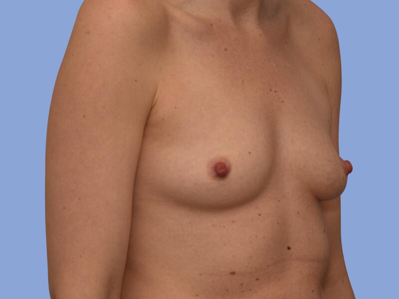 Breast reconstruction before & after photo