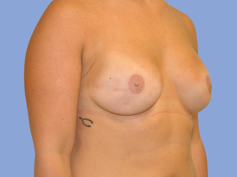 Breast reconstruction before & after photo