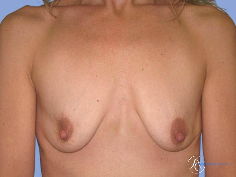 Breast reconstruction before & after photo