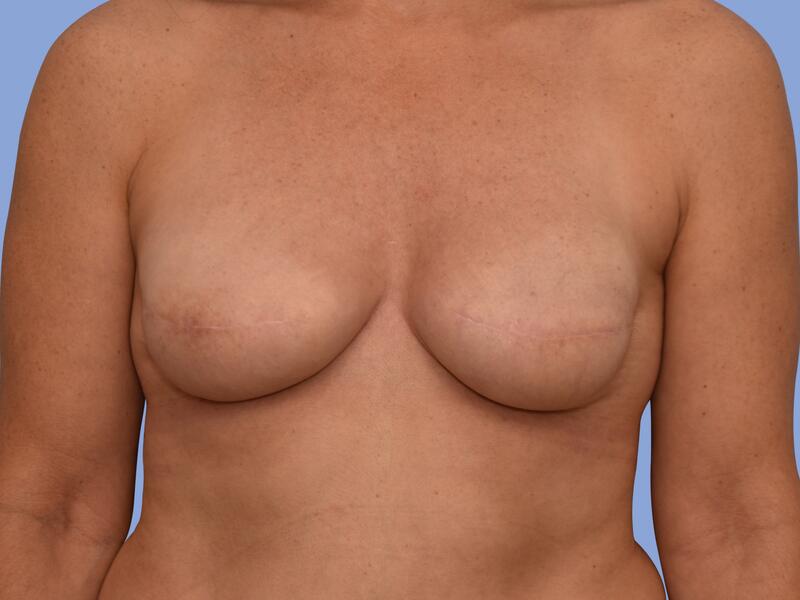 Breast reconstruction before & after photo