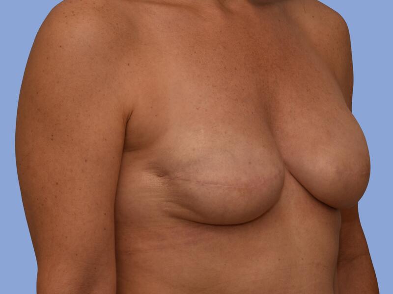 Breast reconstruction before & after photo